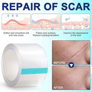 aliver Clear Silicone scar Sheets For Face & Body